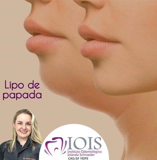 Lipo de Papada